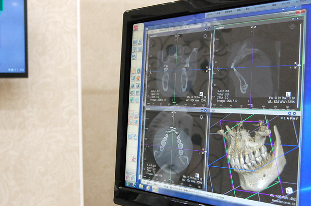 エムズ歯科コピオインプラントについてより精密な治療を行うためのCT完備