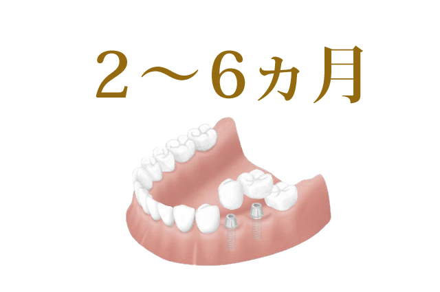 エムズ歯科コピオインプラントについてインプラントは埋め込んでから結合まで時間がかかります